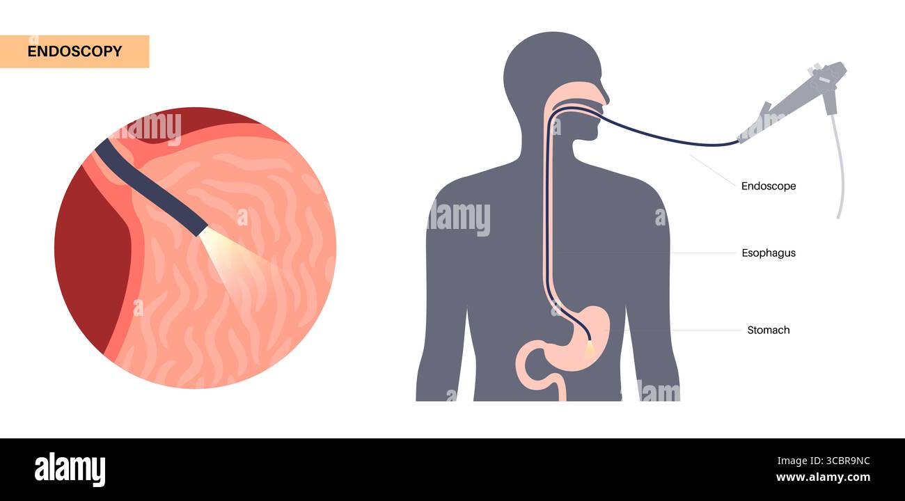 Illustrazione di una gastroscopia, nota anche come endoscopia superiore. Si tratta di una procedura in cui un endoscopio viene inserito attraverso la bocca per esaminare l'esofago, lo stomaco e il duodeno. Aiuta a diagnosticare e trattare condizioni come ulcere, infiammazione o tumori nel tratto digestivo superiore. Foto Stock