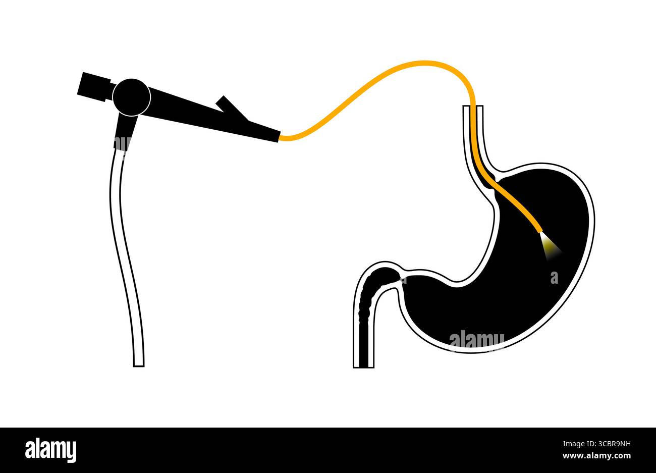 Illustrazione di una gastroscopia, nota anche come endoscopia superiore. Si tratta di una procedura in cui un endoscopio viene inserito attraverso la bocca per esaminare l'esofago, lo stomaco e il duodeno. Aiuta a diagnosticare e trattare condizioni come ulcere, infiammazione o tumori nel tratto digestivo superiore. Foto Stock