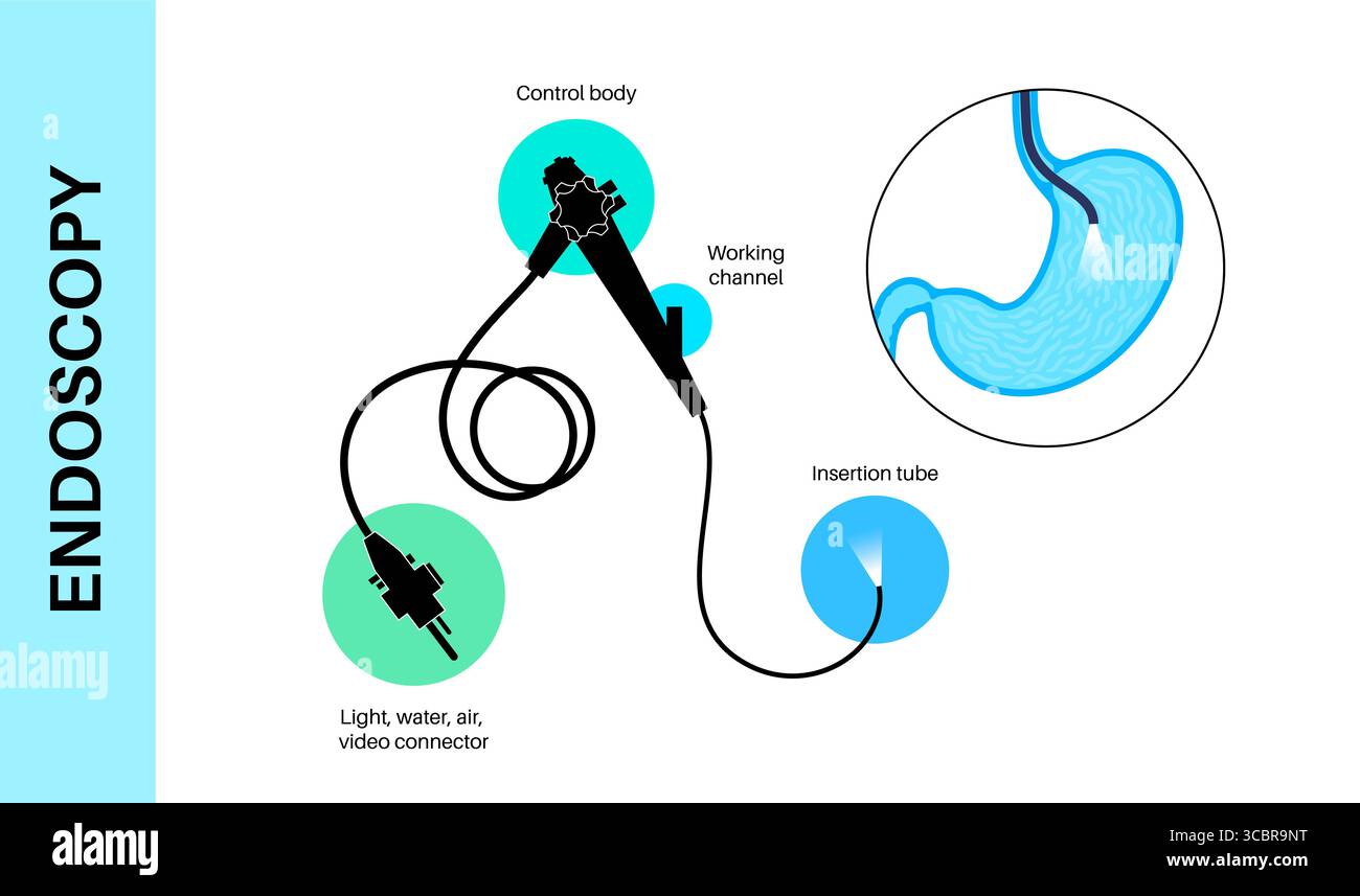 Illustrazione di una gastroscopia, nota anche come endoscopia superiore. Si tratta di una procedura in cui un endoscopio viene inserito attraverso la bocca per esaminare l'esofago, lo stomaco e il duodeno. Aiuta a diagnosticare e trattare condizioni come ulcere, infiammazione o tumori nel tratto digestivo superiore. Foto Stock