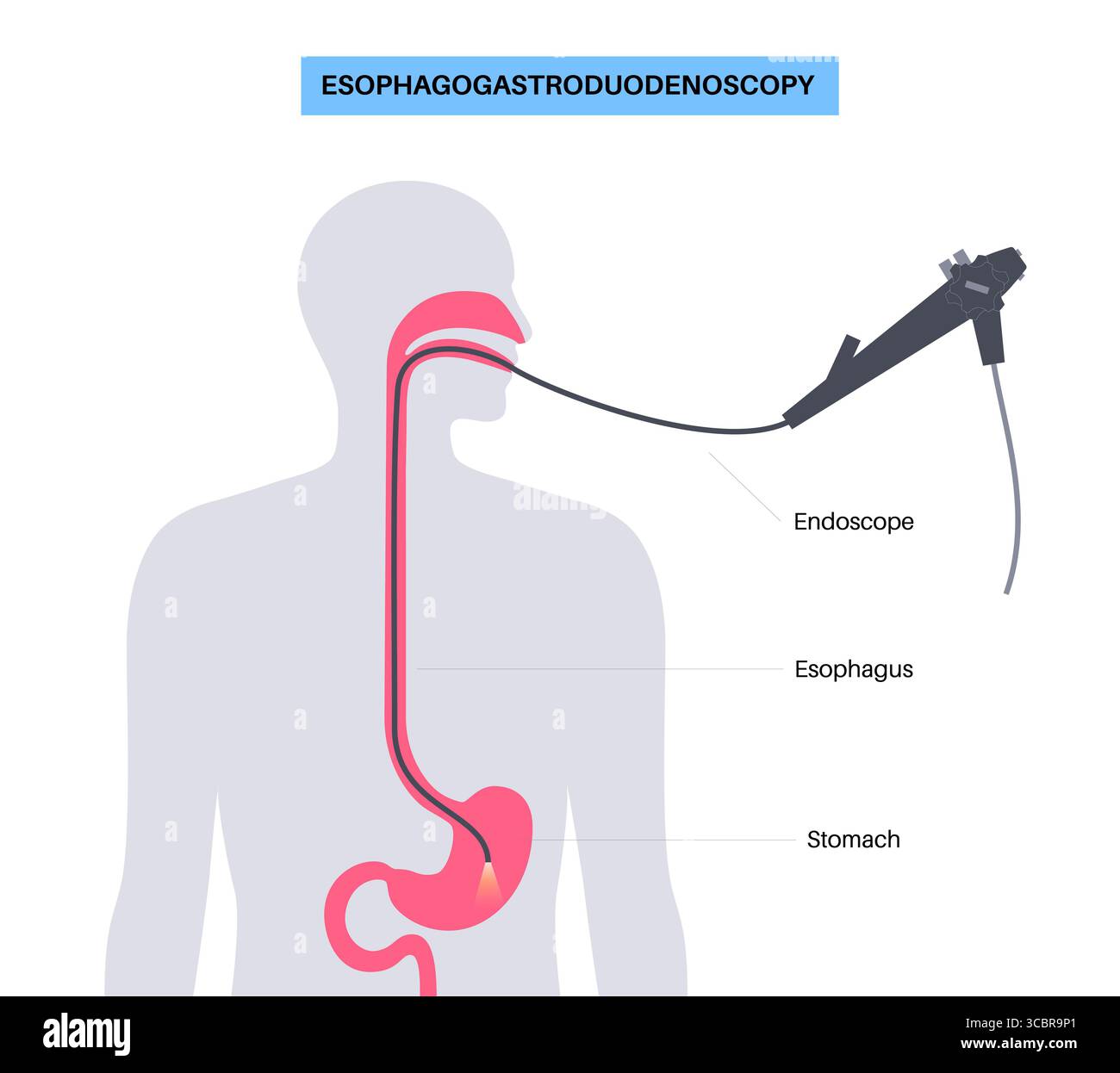 Illustrazione di una gastroscopia, nota anche come endoscopia superiore. Si tratta di una procedura in cui un endoscopio viene inserito attraverso la bocca per esaminare l'esofago, lo stomaco e il duodeno. Aiuta a diagnosticare e trattare condizioni come ulcere, infiammazione o tumori nel tratto digestivo superiore. Foto Stock