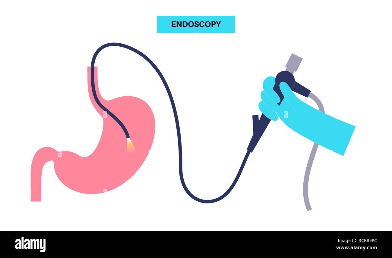 Illustrazione di una gastroscopia, nota anche come endoscopia superiore. Si tratta di una procedura in cui un endoscopio viene inserito attraverso la bocca per esaminare l'esofago, lo stomaco e il duodeno. Aiuta a diagnosticare e trattare condizioni come ulcere, infiammazione o tumori nel tratto digestivo superiore. Foto Stock