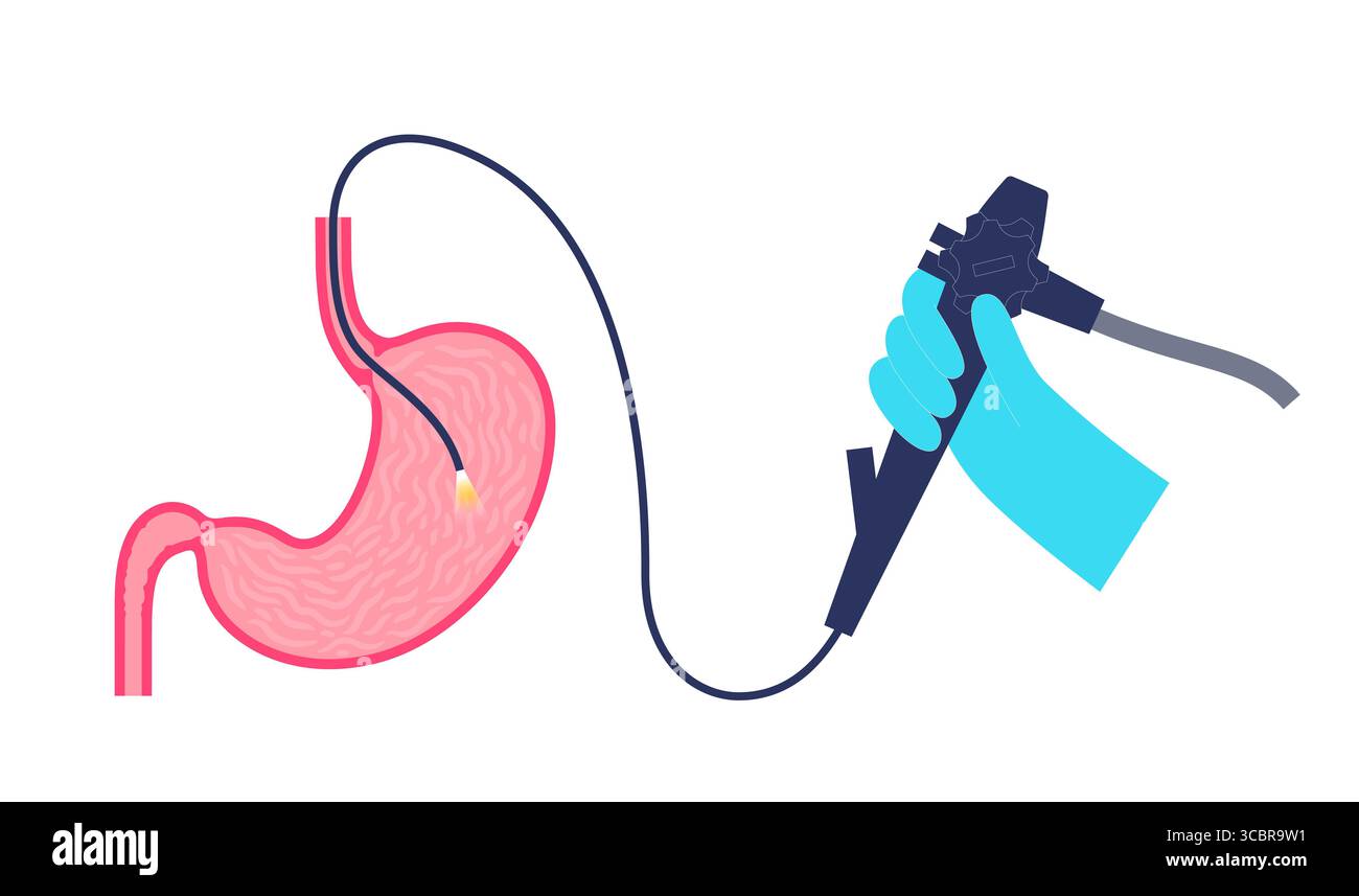 Illustrazione di una gastroscopia, nota anche come endoscopia superiore. Si tratta di una procedura in cui un endoscopio viene inserito attraverso la bocca per esaminare l'esofago, lo stomaco e il duodeno. Aiuta a diagnosticare e trattare condizioni come ulcere, infiammazione o tumori nel tratto digestivo superiore. Foto Stock