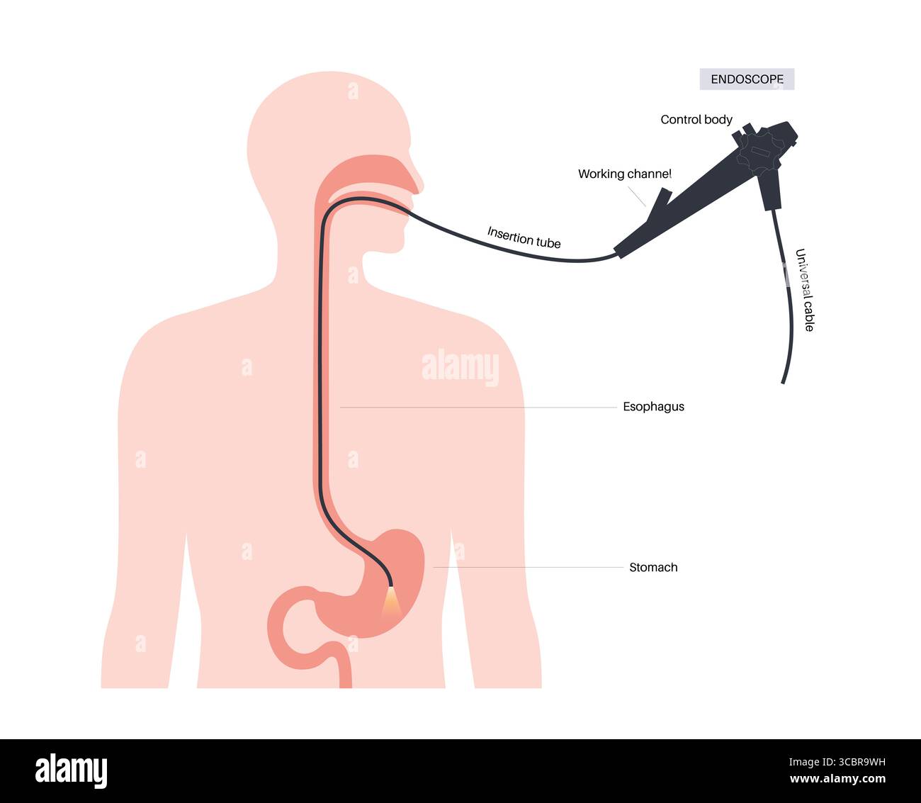 Illustrazione di una gastroscopia, nota anche come endoscopia superiore. Si tratta di una procedura in cui un endoscopio viene inserito attraverso la bocca per esaminare l'esofago, lo stomaco e il duodeno. Aiuta a diagnosticare e trattare condizioni come ulcere, infiammazione o tumori nel tratto digestivo superiore. Foto Stock