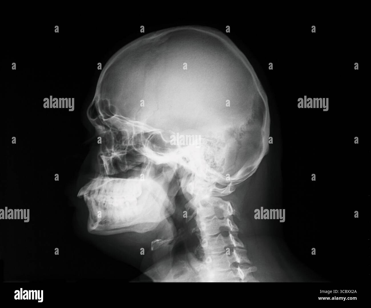 Risonanza magnetica RM immagine del cranio umano. Vista laterale. Immagine a raggi X della testa umana. Foto Stock