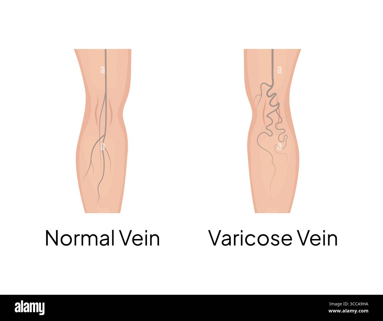 Confronto di vene normali e varicose nella gamba umana Illustrazione Vettoriale