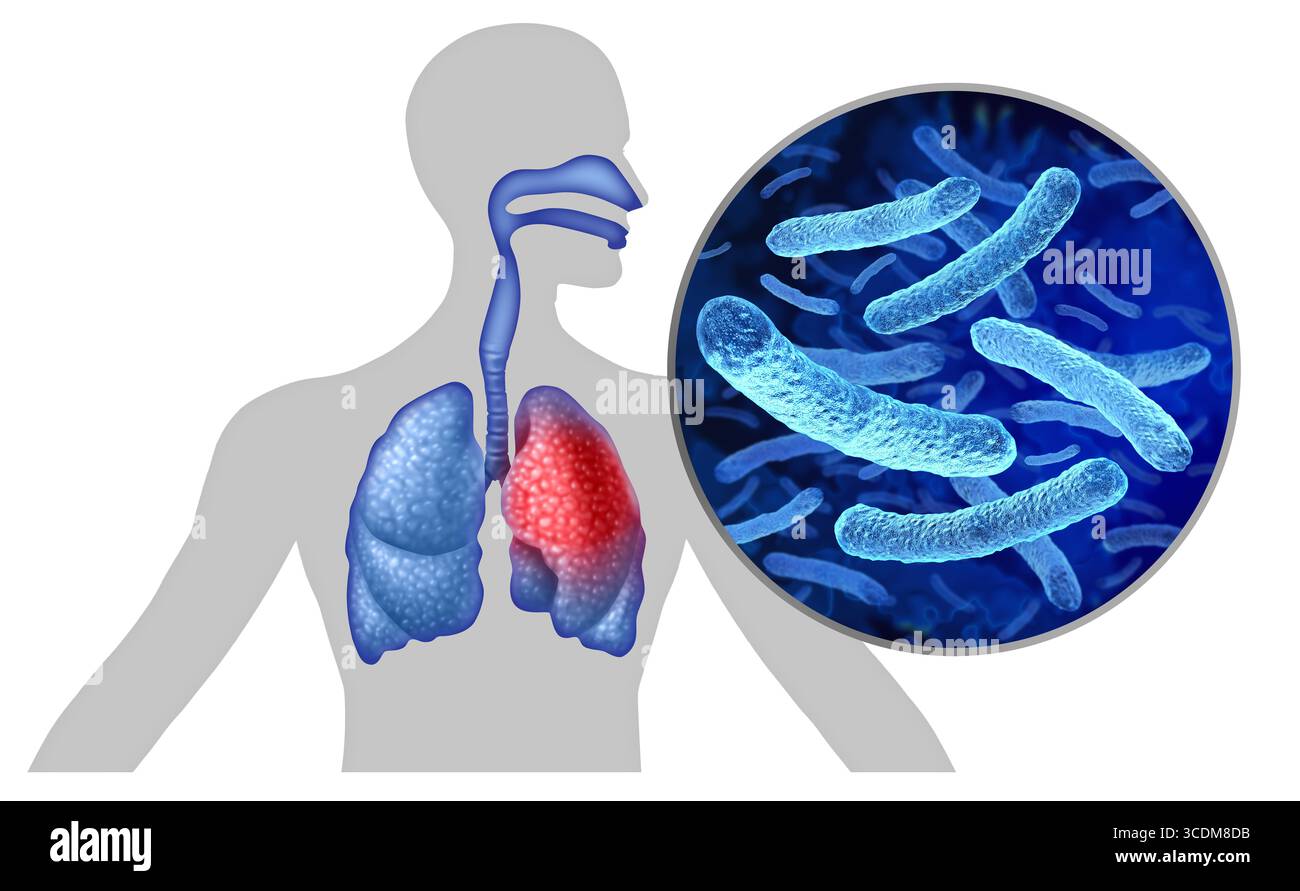 I sintomi della malattia dei legionari e i batteri della Legionella pneumophila focolaio e la malattia respiratoria come una forma grave di polmonite come una microb patologica Foto Stock
