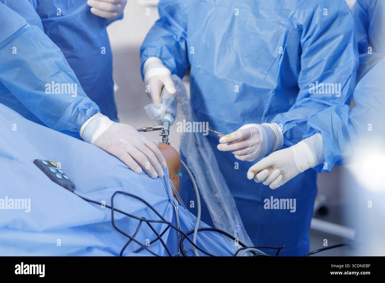 Legamento crociato posteriore, ricostruzione PCL, lacerazione meniscale, lesione cartilagine, trapianto o tunnel di innesto, team ortopedico, lavoro perioperatorio Foto Stock