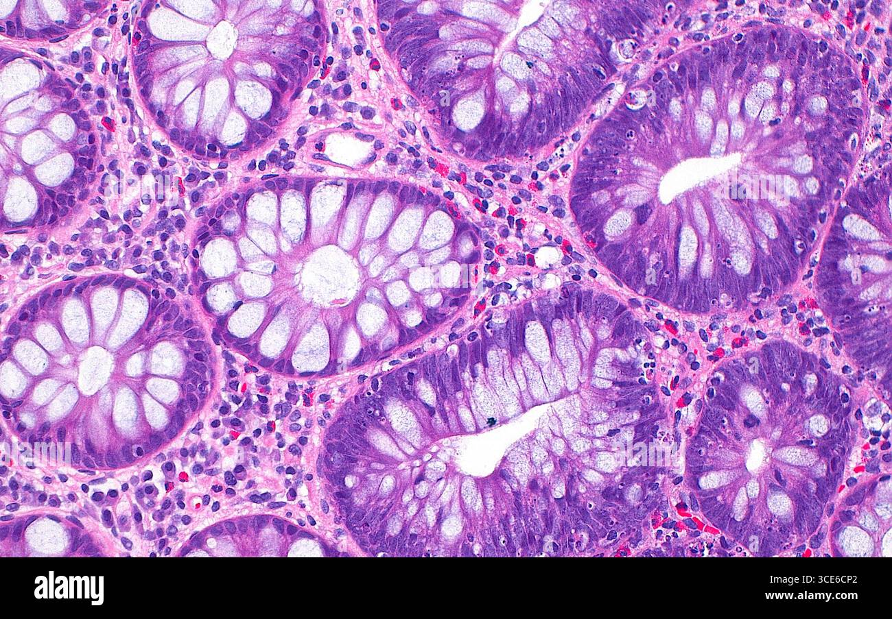 Micrografia leggera di un adenoma tubolare. Un adenoma tubulare è una crescita polipoide che si verifica nel colon ed è una lesione precancerosa, o una lesione che comporta un rischio di sviluppo del cancro. L'adenoma tubolare è identificato da nuclei scuri e allungati a forma di matita (viola scuro, metà destra dell'immagine). Al contrario, le normali cripte del colon (metà sinistra dell'immagine) hanno nuclei più piccoli che non sono allungati o scuri. Sezione di tessuto colorato con ematossilina ed eosina. Ingrandimento: 200x se stampato a 10 cm. Foto Stock