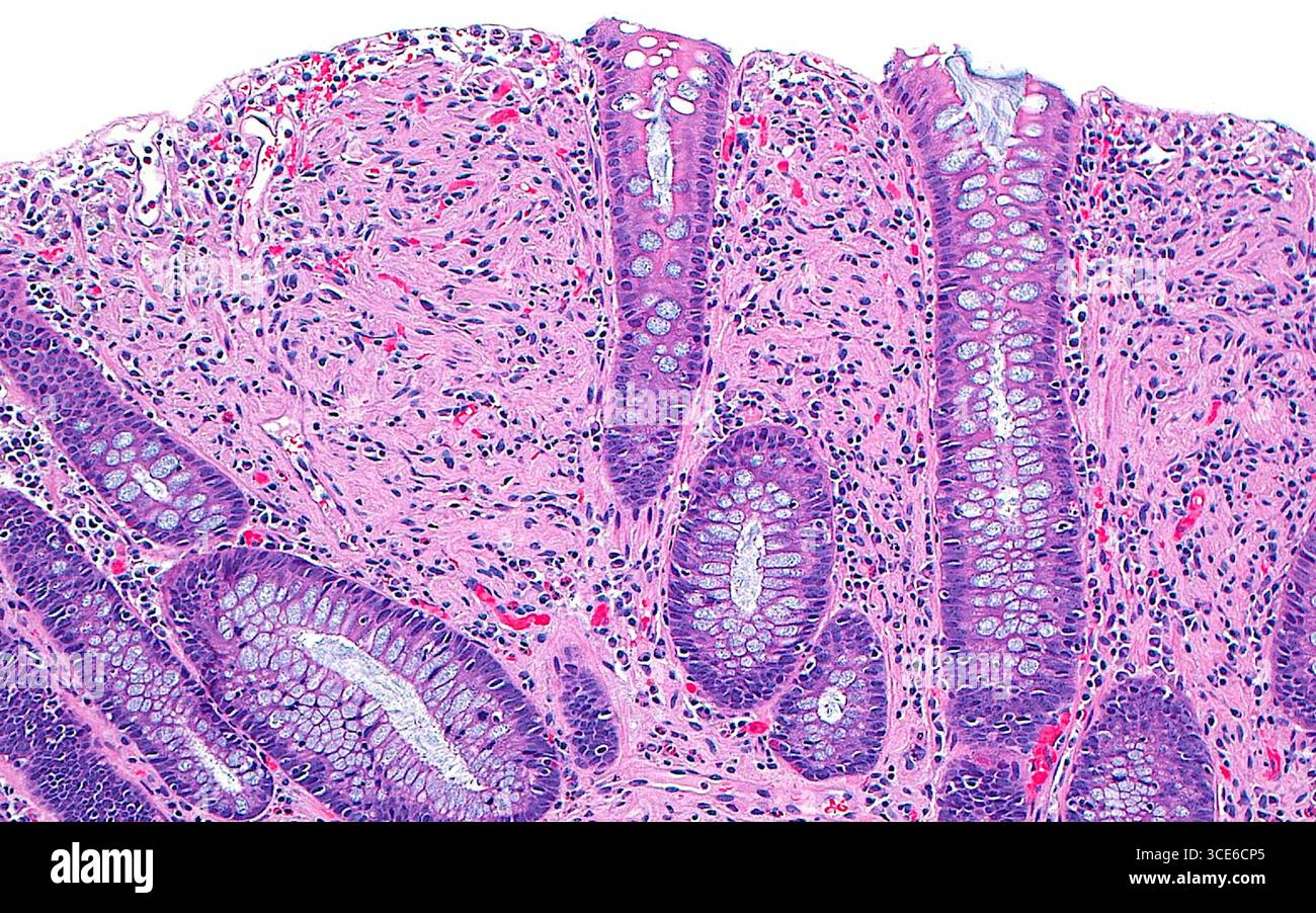 Micrografia leggera dell'hamartoma a cellule di Schwann, che è una crescita benigna di cellule di tipo guaina nervosa periferica che si verifica nel tratto gastrointestinale. La lesione è costituita da cellule a stelo (aree rosa) tra le cripte del colon (strutture allungate dal rosa più scuro al viola). Le cripte del colon contengono numerose cellule di calice (rotonde, blu pallido). Anche piccoli vasi sanguigni contenenti globuli rossi (rosso brillante) sono visti sparsi all'interno della proliferazione. Sezione di tessuto colorato con ematossilina ed eosina. Ingrandimento: 100x se stampato a 10 cm. Foto Stock