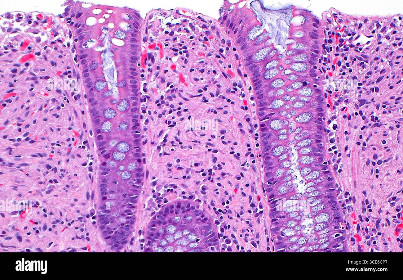 Micrografia leggera dell'hamartoma a cellule di Schwann, che è una crescita benigna di cellule di tipo guaina nervosa periferica che si verifica nel tratto gastrointestinale. La lesione è costituita da cellule a stelo (aree rosa) tra le cripte del colon (strutture allungate dal rosa più scuro al viola). Le cripte del colon contengono numerose cellule di calice (rotonde, blu pallido). Anche piccoli vasi sanguigni contenenti globuli rossi (rosso brillante) sono visti sparsi all'interno della proliferazione. Sezione di tessuto colorato con ematossilina ed eosina. Ingrandimento: 200x se stampato a 10 cm. Foto Stock