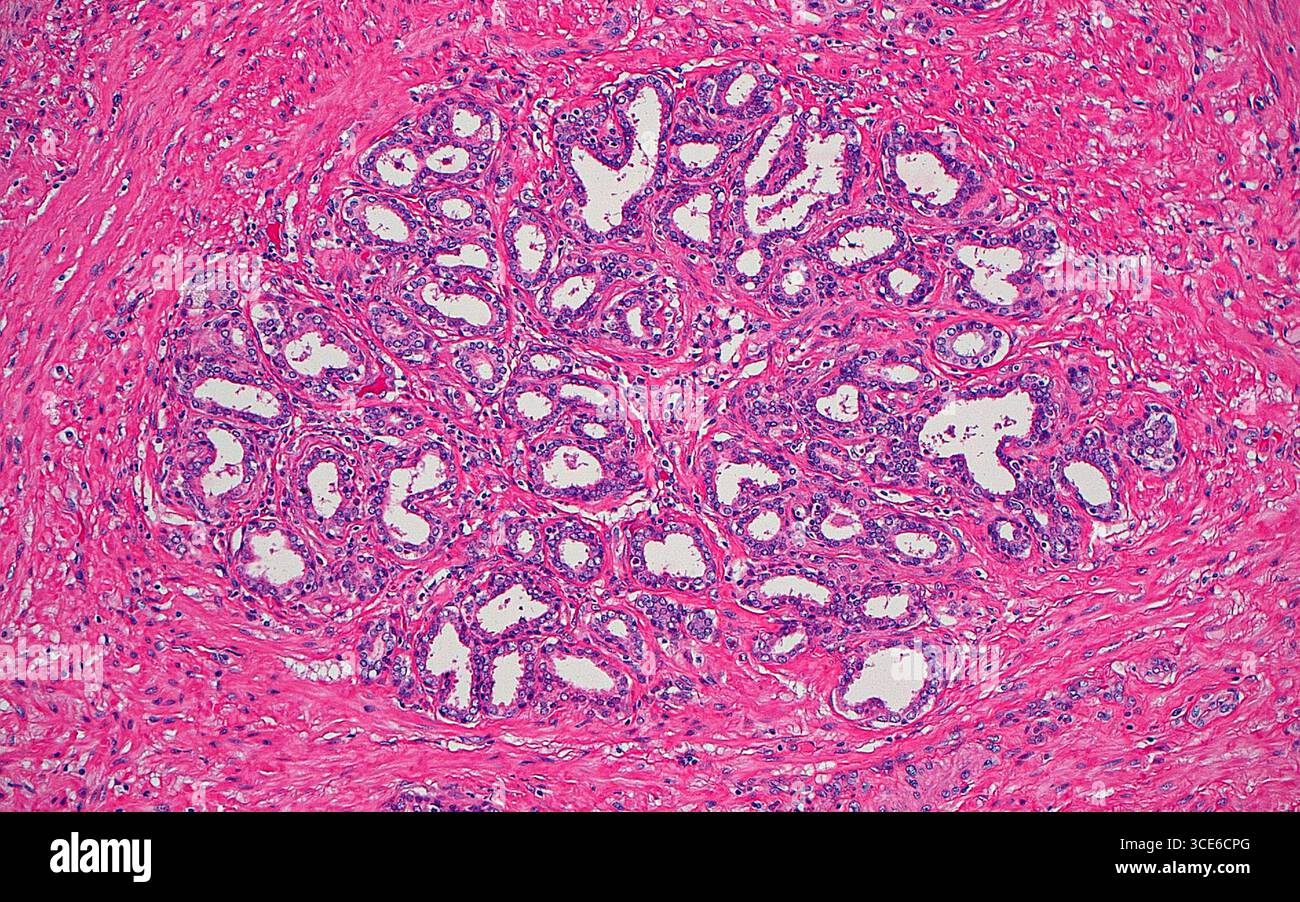 Atrofia lobulare della prostata, micrografia leggera Foto Stock
