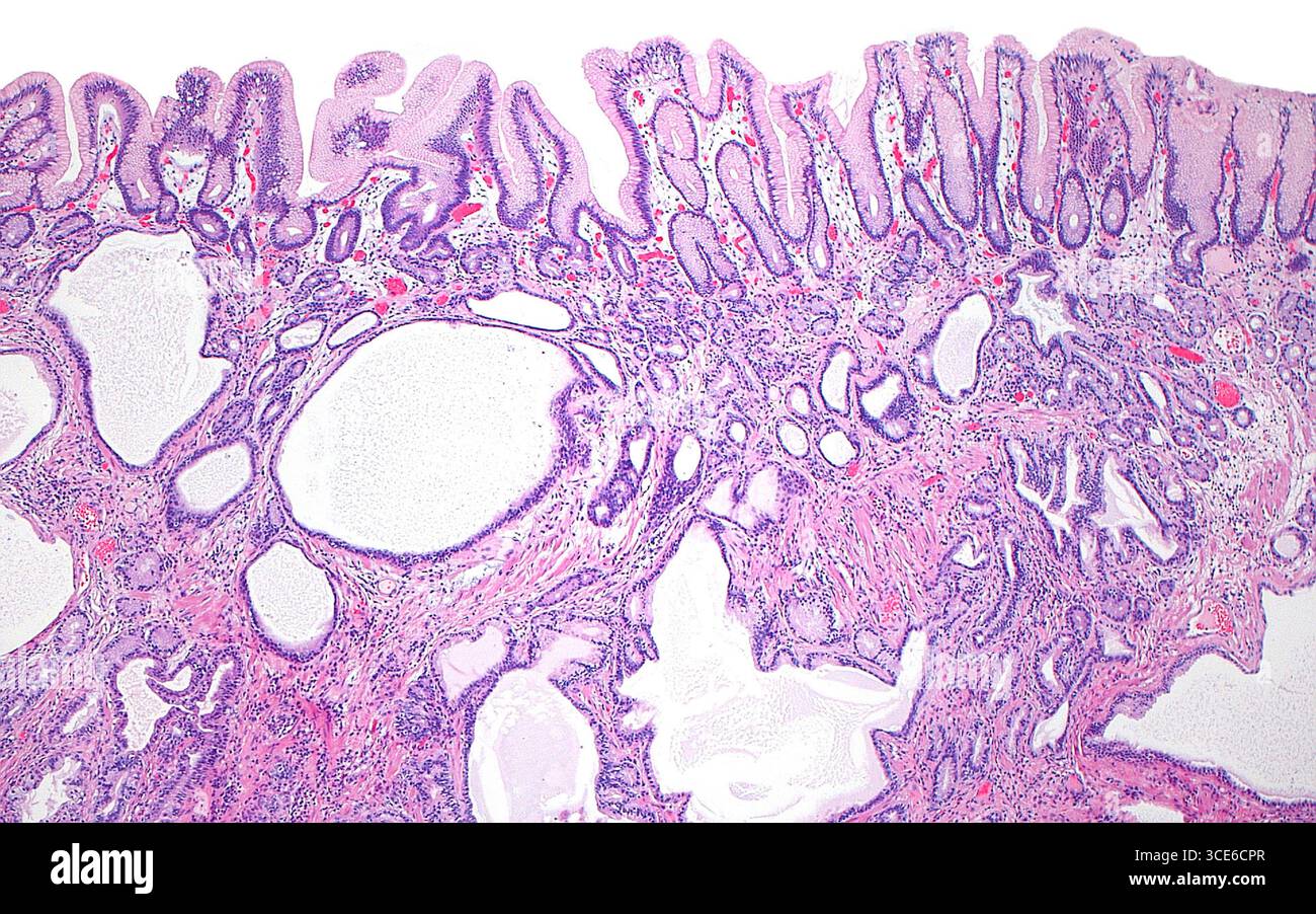 Micrografia leggera della gastrite cistica profunda, che è una condizione benigna che si verifica nello stomaco più comunemente nei pazienti con precedente intervento chirurgico che coinvolge lo stomaco. La lesione è costituita da ghiandole gastriche dilatate e di forma irregolare (spazi bianchi nei tre quarti inferiori dell'immagine) sotto le ghiandole gastriche normali (banda orizzontale nella parte superiore dell'immagine). Sezione di tessuto colorato con ematossilina ed eosina. Ingrandimento: 40x se stampato a 10 cm. Foto Stock