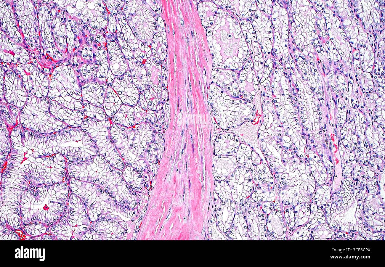 Micrografia leggera del carcinoma a cellule renali con stroma fibromiomatoso. Questo tipo di cancro renale ha cellule con citoplasma chiaro (bianco) e bande intersecanti di muscolo liscio e cellule fibrose (fascia rosa che si sviluppa verticalmente al centro dell'immagine). Sezione di tessuto colorato con ematossilina ed eosina. Ingrandimento: 100x se stampato a 10 cm. Foto Stock