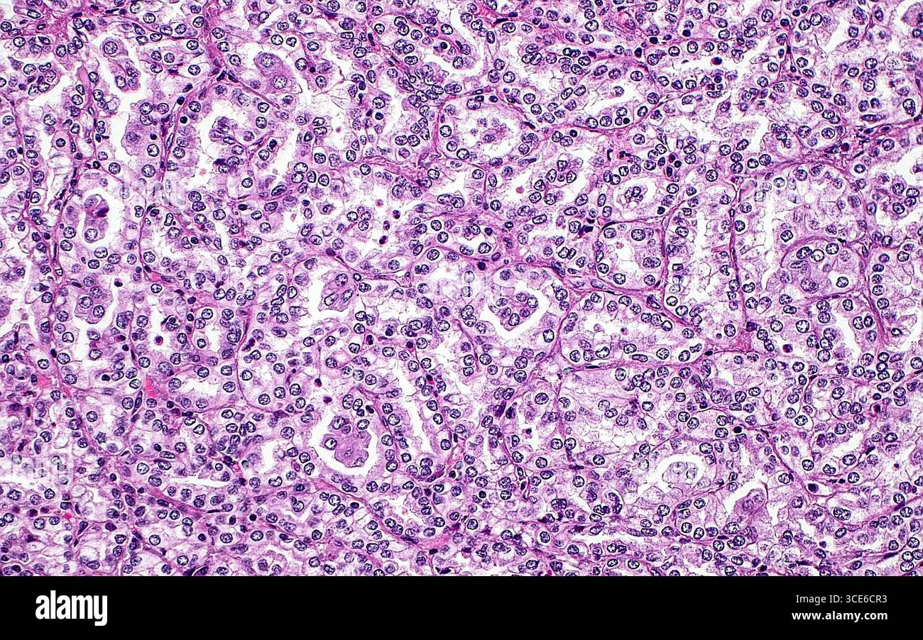 Micrografia leggera del carcinoma papillare a cellule renali. Il carcinoma papillare a cellule renali è un sottotipo di cancro renale. Uno dei modelli microscopici osservati in questo tumore è la formazione di tubuli compressi, come mostrato in questa immagine. Sezione di tessuto colorato con ematossilina ed eosina. Ingrandimento: 200x se stampato a 10 cm. Foto Stock