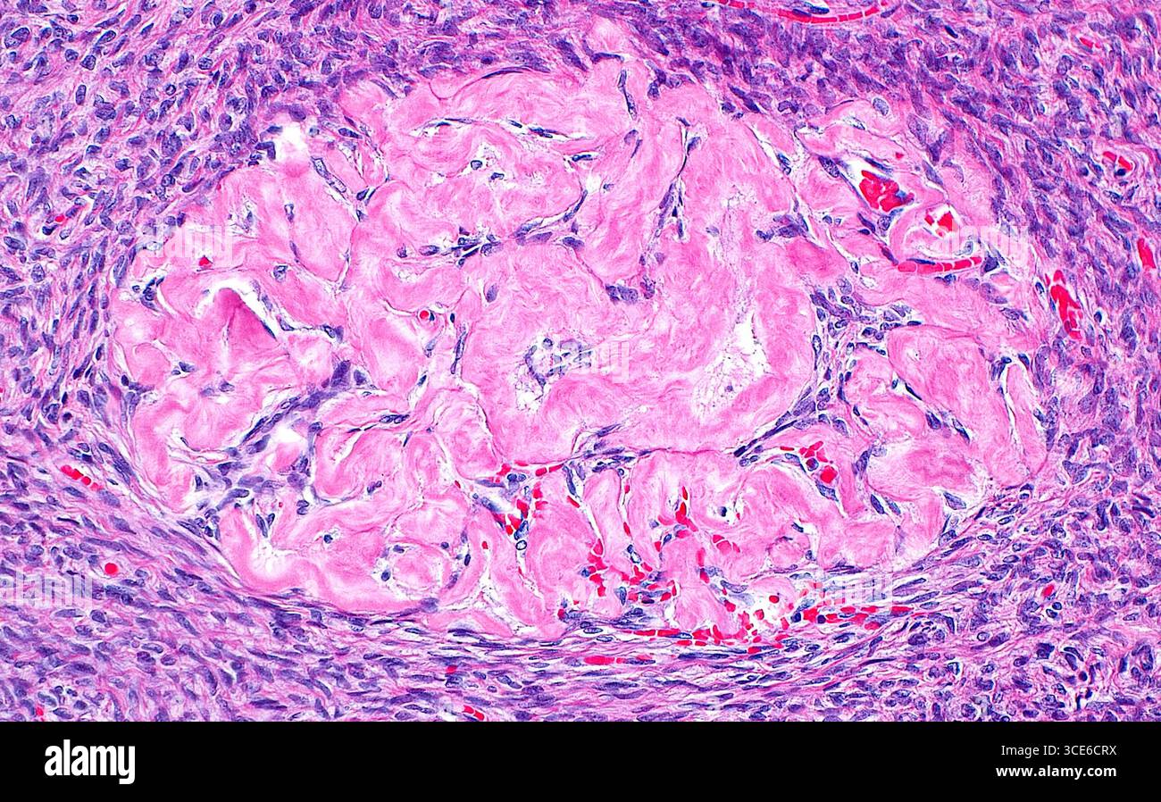 Corpus albicans di ovaio, micrografia leggera Foto Stock