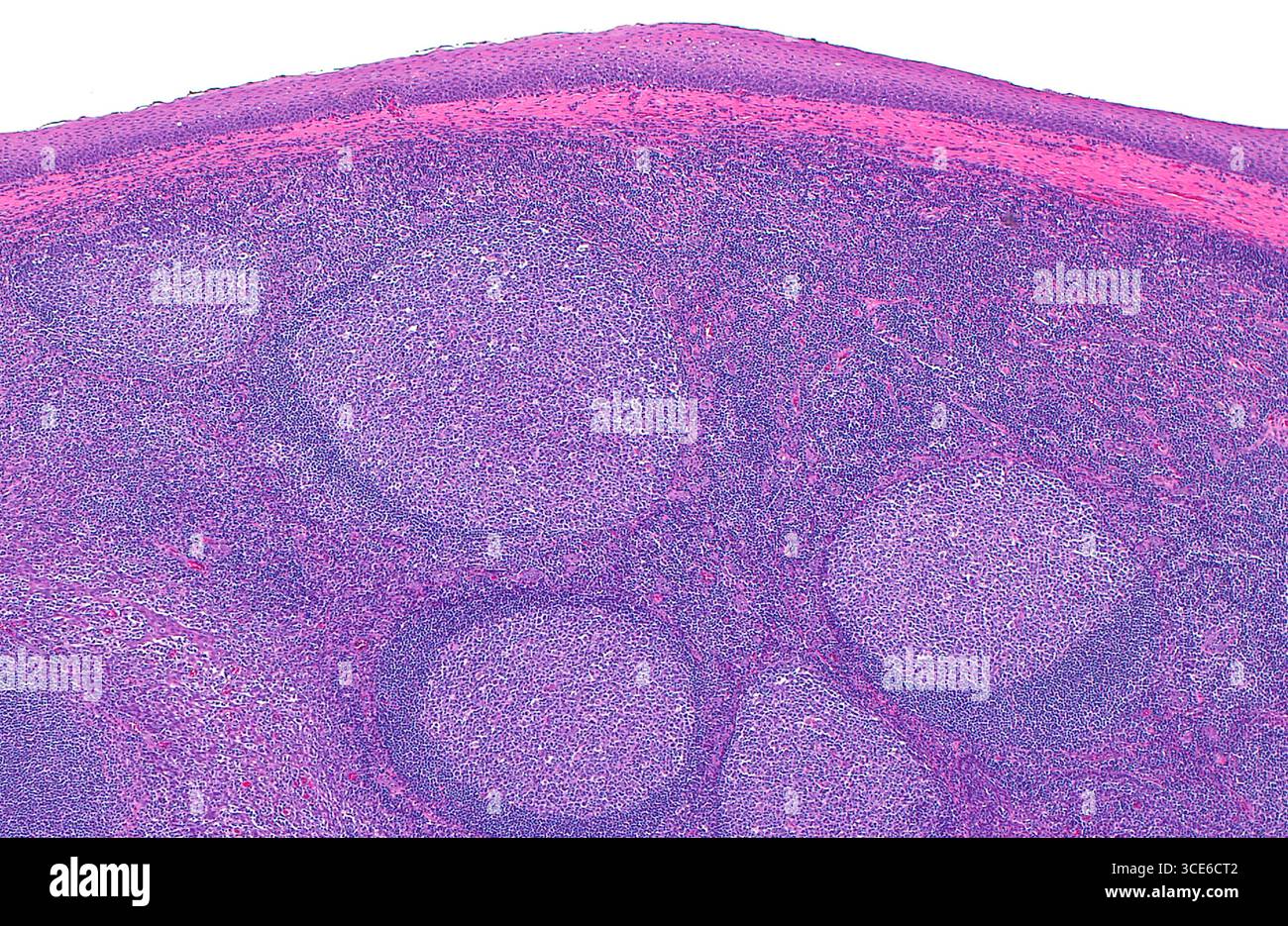Micrografia leggera di una tonsilla. Le tonsille sono composte da tessuto linfoide (area blu dell'immagine) sotto il tessuto epiteliale, in questo caso mucosa squamosa dell'orofaringe (banda curva viola in cima all'immagine). Il tessuto linfoide è composto da molti linfociti (innumerevoli piccoli punti blu) che formano follicoli linfoidi (strutture circolari azzurre-viola). Sezione di tessuto colorato con ematossilina ed eosina. Ingrandimento: 40x se stampato a 10 cm. Foto Stock