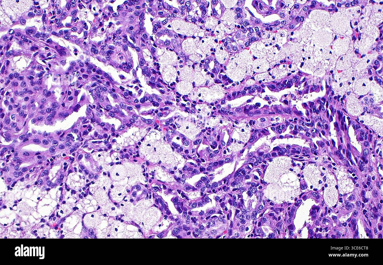 Micrografia leggera del carcinoma papillare a cellule renali. Il carcinoma papillare a cellule renali è un sottotipo di cancro renale. Una delle caratteristiche microscopiche spesso osservate in questo tumore è la presenza di macrofagi schiumosi (aggregati azzurri-bianchi di strutture circolari), come si vede in questa immagine. Sezione di tessuto colorato con ematossilina ed eosina. Ingrandimento: 200x se stampato a 10 cm. Foto Stock