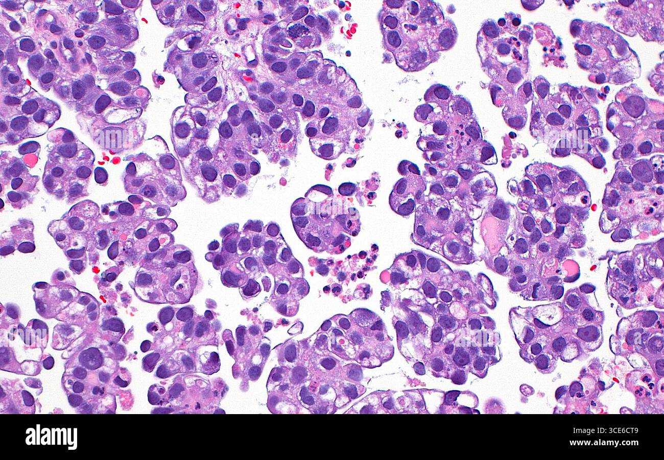 Micrografia leggera dell'adenocarcinoma a cellule chiare dell'utero, un raro sottotipo di cancro dell'utero. Le cellule tumorali presentano nuclei rotondi (punti blu) ed eosinofili (rosa) per eliminare il citoplasma (bianco). Le cellule tumorali sono disposte in gruppi. Sezione di tessuto colorato con ematossilina ed eosina. Ingrandimento: 200x se stampato a 10 cm. Foto Stock