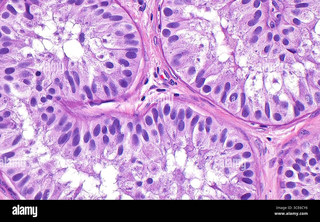 Sindrome di Sertoli solo cellulare, micrografia leggera Foto Stock