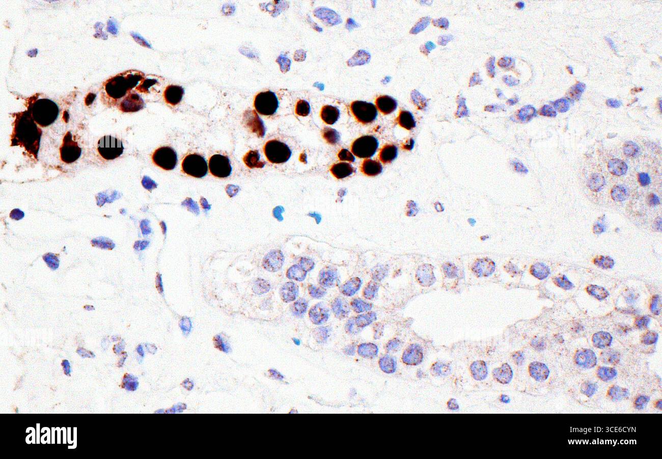 Micrografia leggera della nefropatia da virus BK. Il virus BK può infettare i reni trapiantati nei pazienti a causa del compromesso immunitario da farmaci immunosoppressivi che questi pazienti devono assumere. Le particelle virali sono presenti all'interno dei nuclei delle cellule tubulari renali e sono visibili in questa immagine evidenziata in marrone (punti marroni) da una macchia immunoistochimica che utilizzava anticorpi contro gli antigeni presenti nelle particelle del virus BK. Ingrandimento: 40x se stampato a 10 cm. Foto Stock