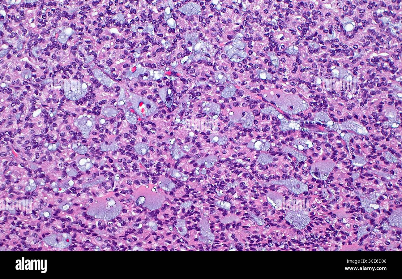 Micrografia leggera del carcinoma papillare a cellule renali. Il carcinoma papillare a cellule renali è un sottotipo di cancro renale. Uno dei modelli microscopici osservati in questo tumore è la disposizione delle cellule tumorali (blu-viola) come strutture tubulari che a volte contengono mucina (azzurro). Sezione di tessuto colorato con ematossilina ed eosina. Ingrandimento: 100x se stampato a 10 cm. Foto Stock