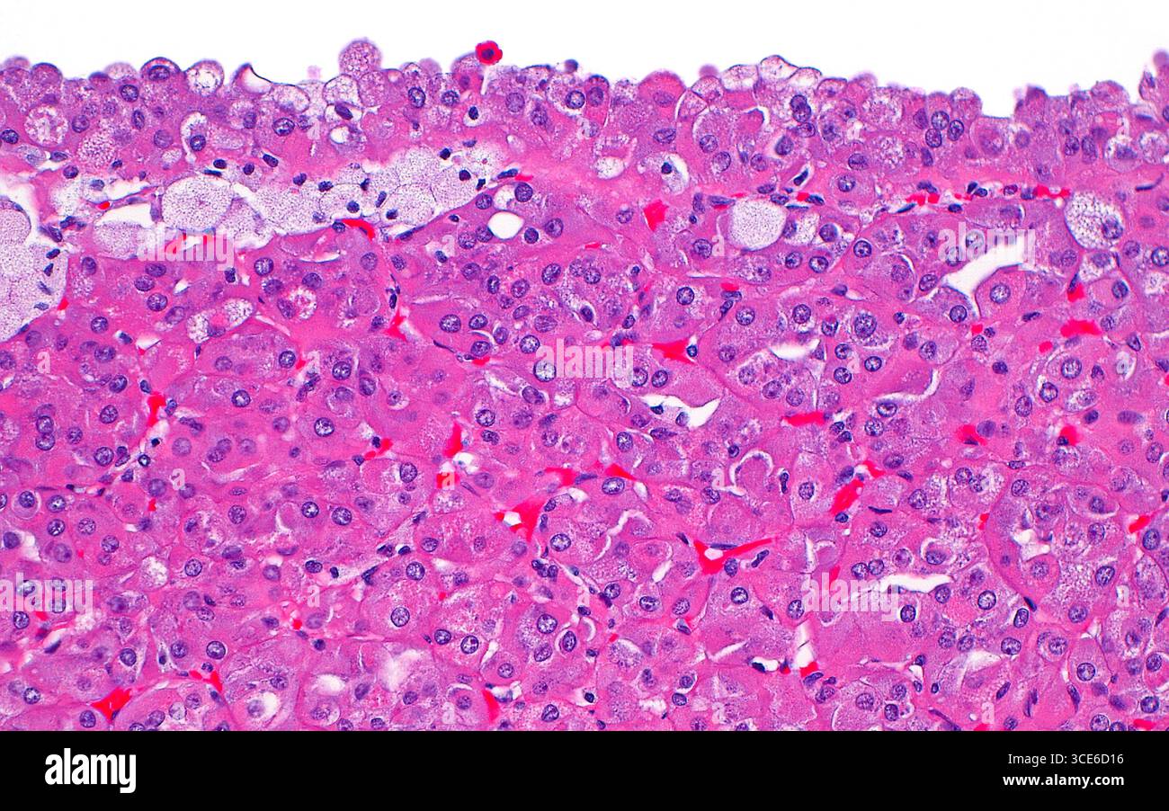 Micrografia leggera del carcinoma a cellule renali cistiche e solide eosinofila. Questo sottotipo di cancro renale ha cellule con abbondante citoplasma eosinofilo (rosa) comunemente disposte intorno a spazi cistici (spazio bianco in cima all'immagine). Le celle hanno anche una configurazione "hobnail" o protrusioni simili a bleb negli spazi cistici (in cima all'immagine). Sezione di tessuto colorato con ematossilina ed eosina. Ingrandimento: 200x se stampato a 10 cm. Foto Stock