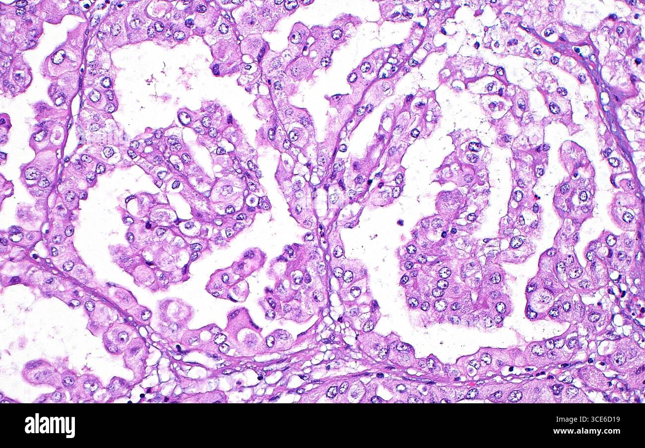 Micrografia leggera della traslocazione t(X,11) del carcinoma a cellule renali. Questo tipo di cancro renale presenta una caratteristica traslocazione tra i cromosomi 11 e il cromosoma X. Istologicamente, questi tumori spesso mostrano cellule con citoplasma eosinofilo (rosa) per eliminare (bianco) abbondante, disposte in strutture papillari (fili sottili e strutture simili a dita). Sezione di tessuto colorato con ematossilina ed eosina. Ingrandimento: 200x se stampato a 10 cm. Foto Stock