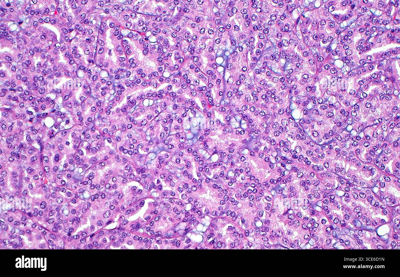 Micrografia leggera del carcinoma a cellule renali a cellule mandrino tubulare mucinoso, che è un tipo di cancro renale. Il tumore è costituito da cellule disposte in tubuli (strutture rotonde e simili a tubi) e presenta mucina intervallata (azzurro). Le cellule del fuso (allungate) erano presenti in altre aree di questo tumore non illustrate qui. Sezione di tessuto colorato con ematossilina ed eosina. Ingrandimento: 200x se stampato a 10 cm. Foto Stock