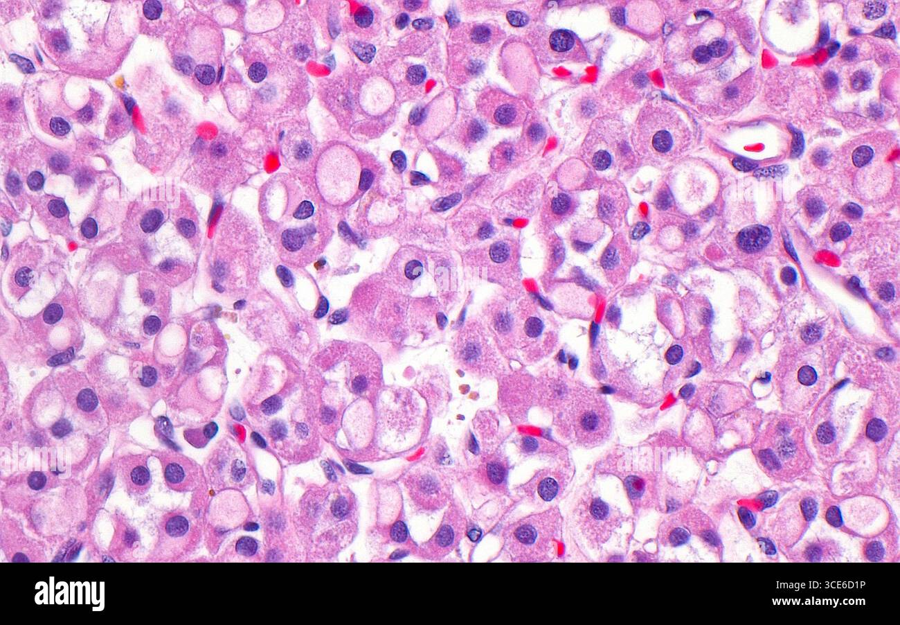 Micrografia leggera del carcinoma a cellule renali carente di succinato deidrogenasi (SDH). Il carcinoma a cellule renali carente di SDH è caratterizzato dall'assenza di un enzima SDH funzionante nelle cellule tumorali. Microscopicamente, questo tumore mostra vacuoli (strutture tonde rosa pallido) e cellule con citoplasma eosinofilo (rosa più scuro). I nuclei delle cellule tumorali sono i punti blu rotondi e in questa immagine è possibile vedere anche alcuni globuli rossi (rosso brillante). Sezione di tessuto colorato con ematossilina ed eosina. Ingrandimento: 400x se stampato a 10 cm. Foto Stock
