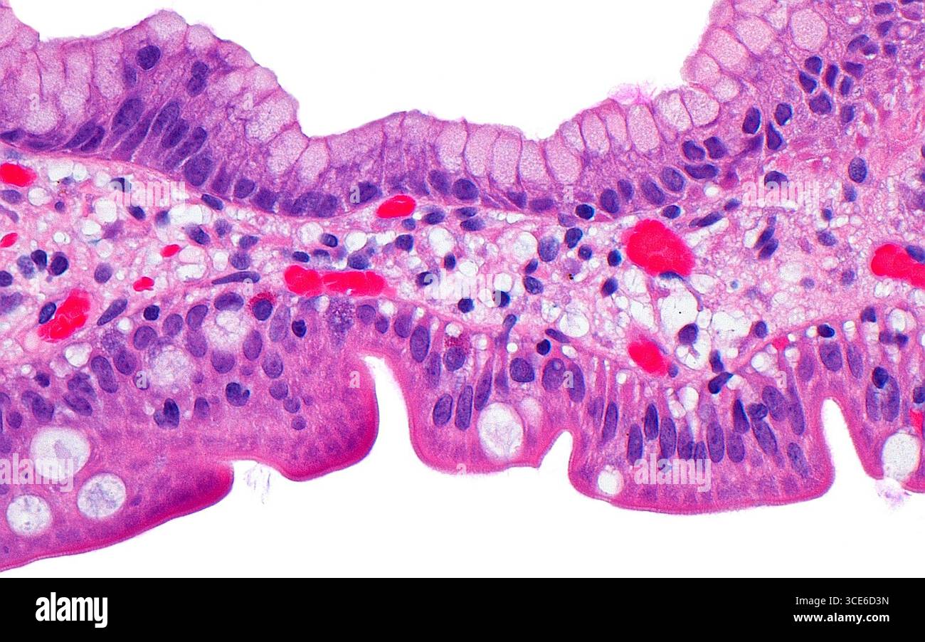 Metaplasia foveolare, micrografia leggera Foto Stock