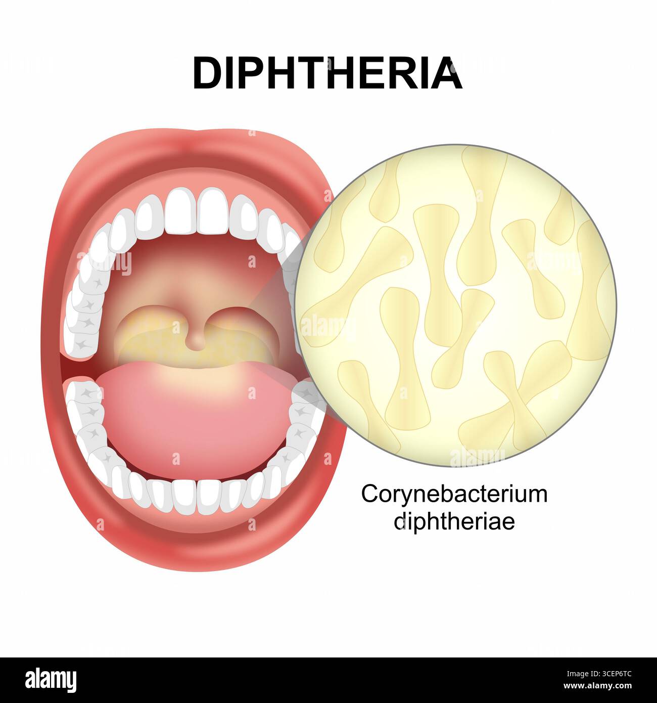 Illustrazione di infezione della bocca della difterite, corynebacterium Diphtheria Foto Stock