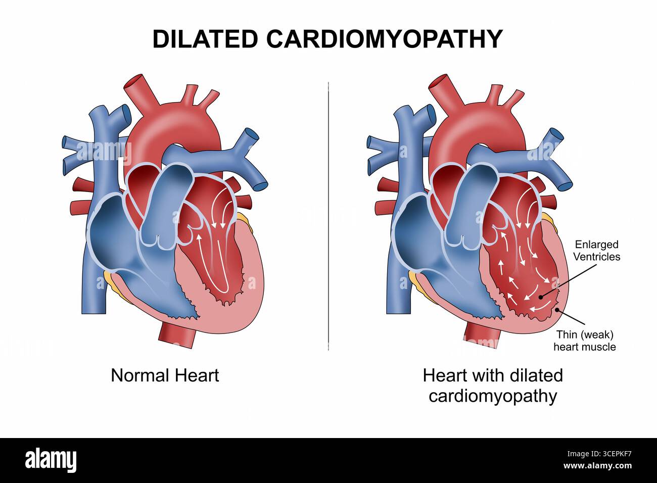 Illustrazione cardiomiopatia dilatata Foto Stock