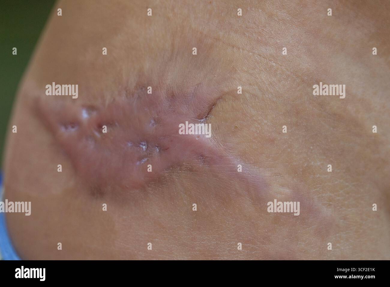 Primo piano di una cicatrice keloide rialzata e grumi che si sviluppa sulla pelle dopo un intervento chirurgico Foto Stock