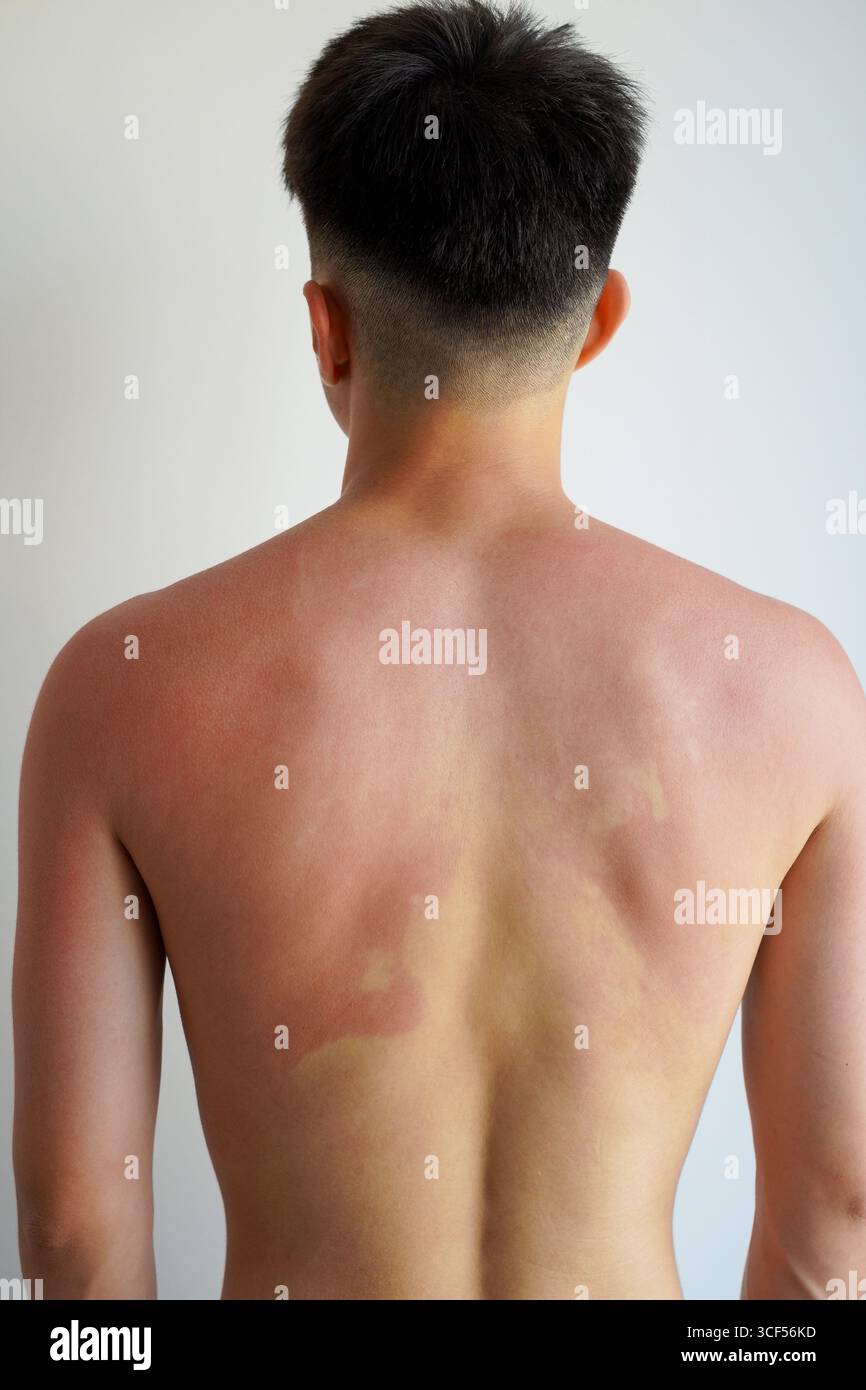 La spalla bruciata al sole di un giovane uomo Foto Stock