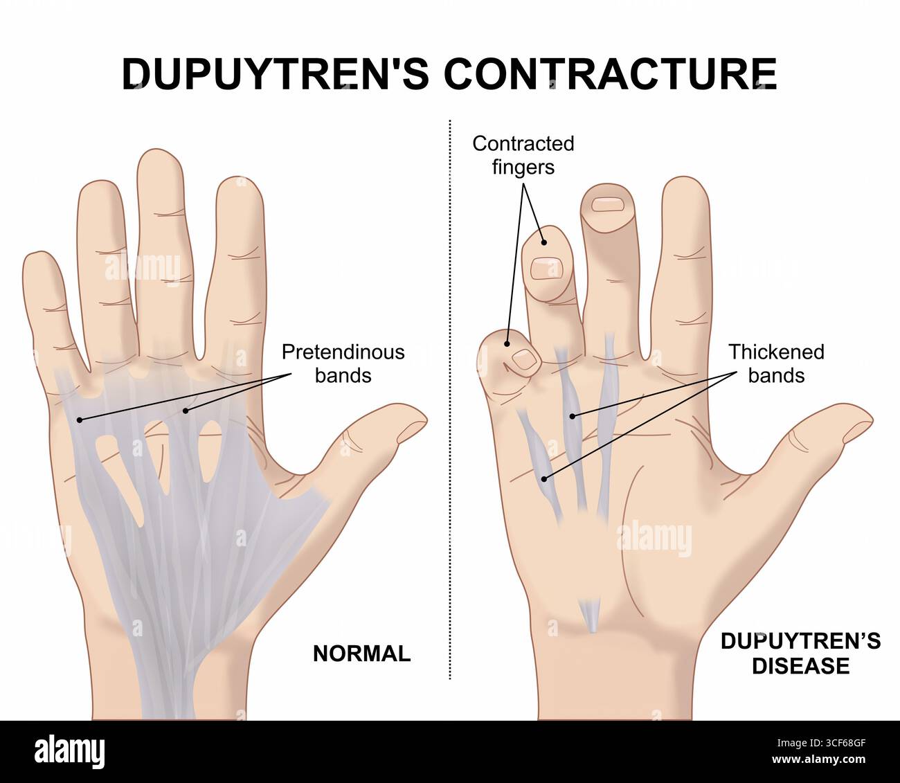 La contrattura Dupuytrens Foto Stock