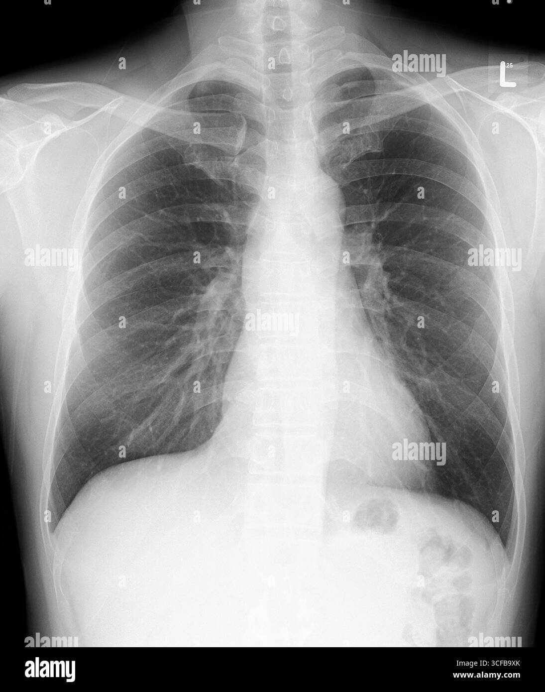 Filmare PA toracico normale. Le dimensioni del cuore, il diaframma e i solchi costofrenici sono normali, nessuna infiltrazione polmonare in entrambi i polmoni, un torace osseo insignificante. Foto Stock
