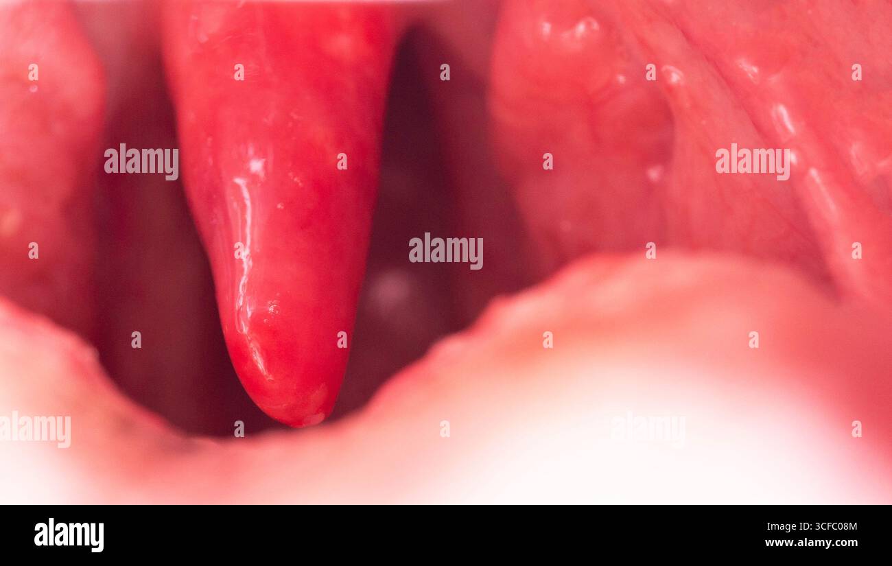 Uvula rossa, infiammata e gonfia in gola. Trattamento dell'uvulite dovuta a batteri e virus streptococcici. Otolaringologia. Copia spazio per il testo Foto Stock