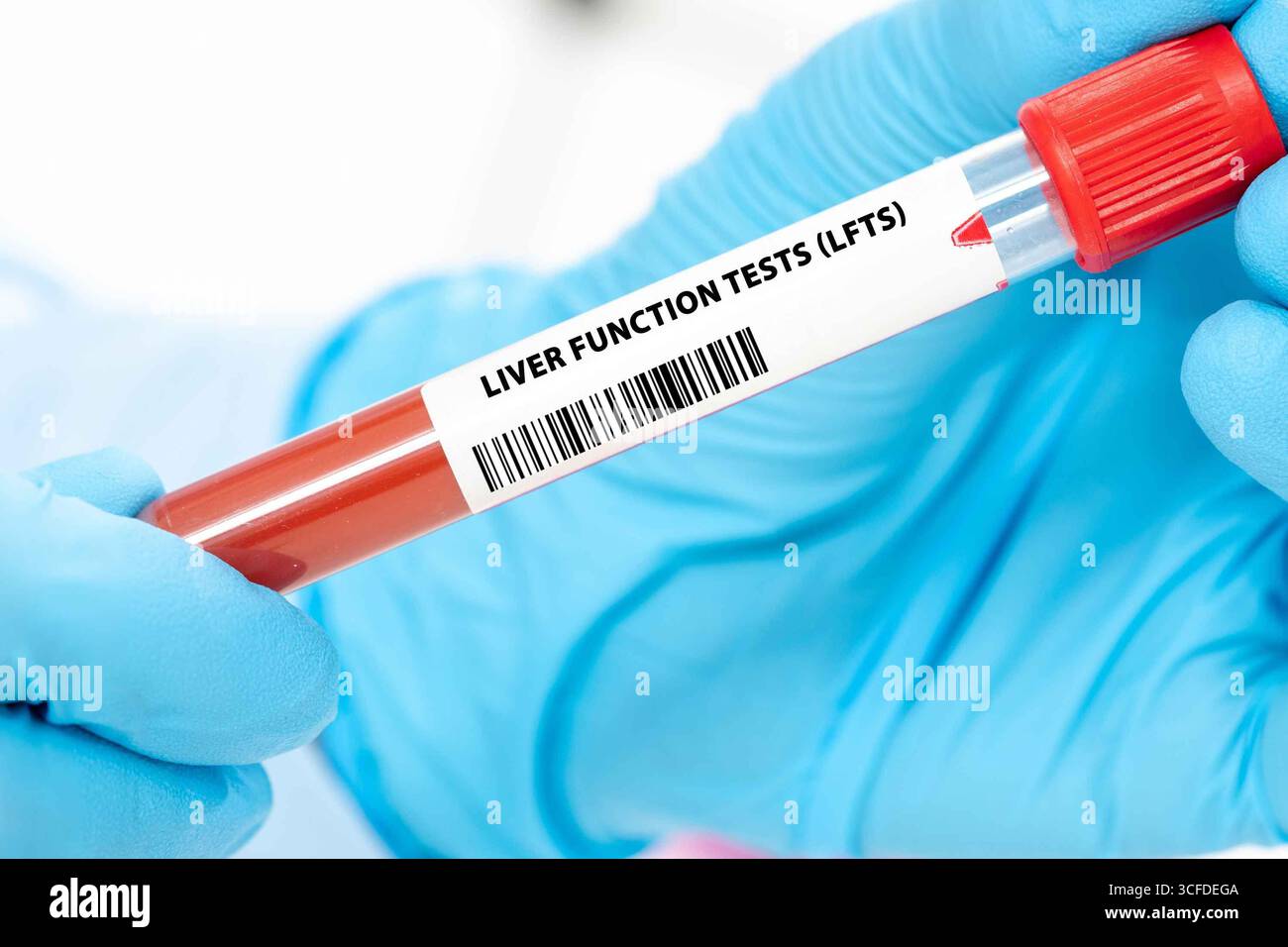 I test di funzionalità epatica (LFT) valutano la salute del fegato misurando enzimi e proteine nel sangue. Foto Stock