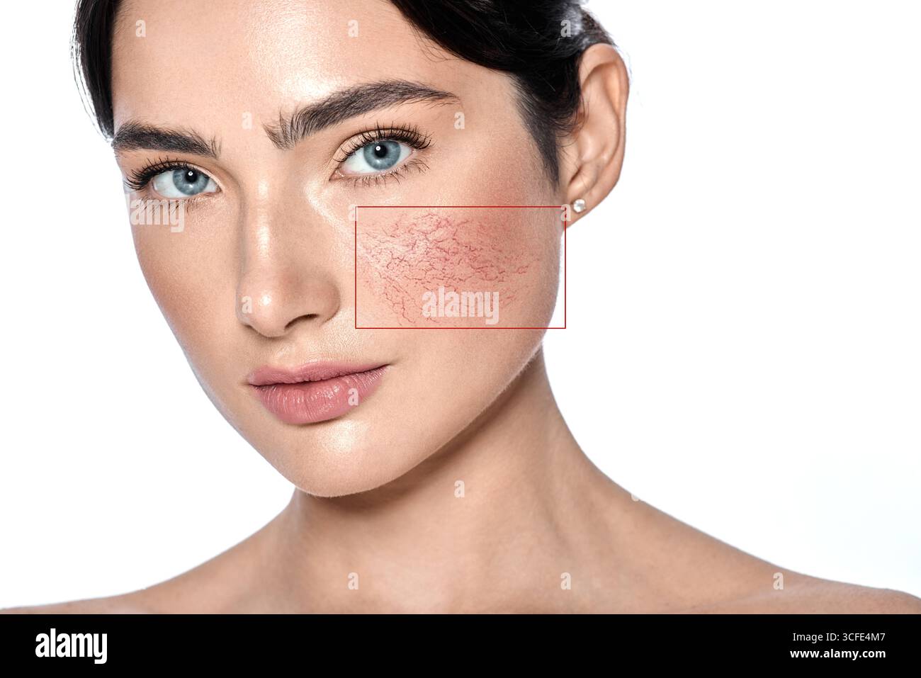 Couperose sulla pelle del viso femminile. Donna che mostra problemi con la pelle sensibile e prona alla couperose, isolata Foto Stock