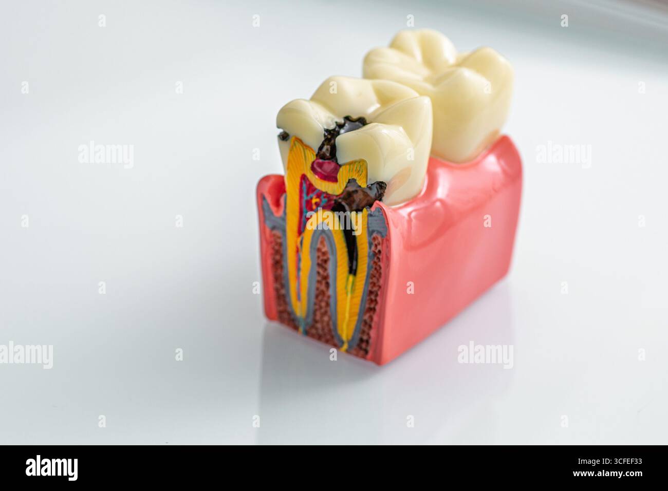 Il modello dentale mostra il dente con la struttura e la cura delle cavità in una luminosa sala di consultazione, sottolineando la salute orale Foto Stock