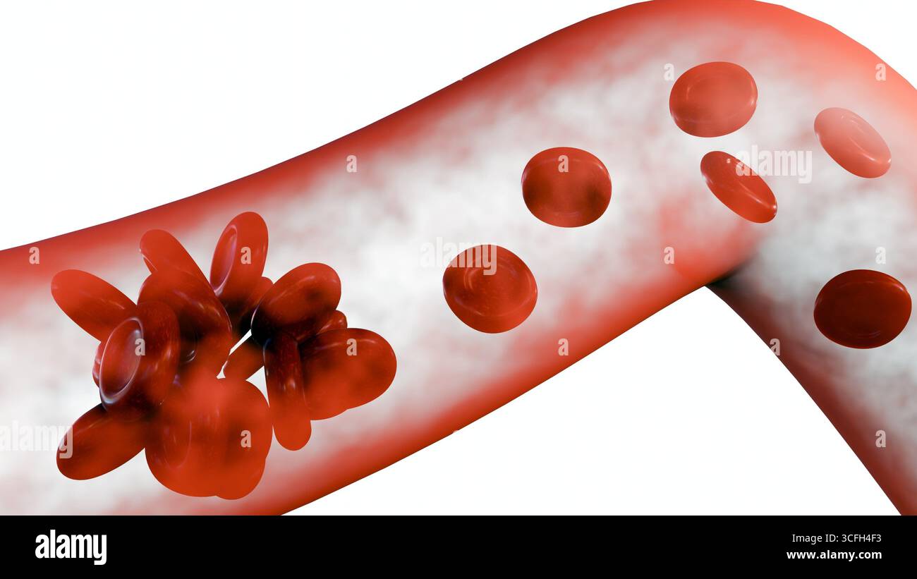 Illustrazione medica 3D di un vaso sanguigno con un coagulo di sangue che si forma. Foto Stock