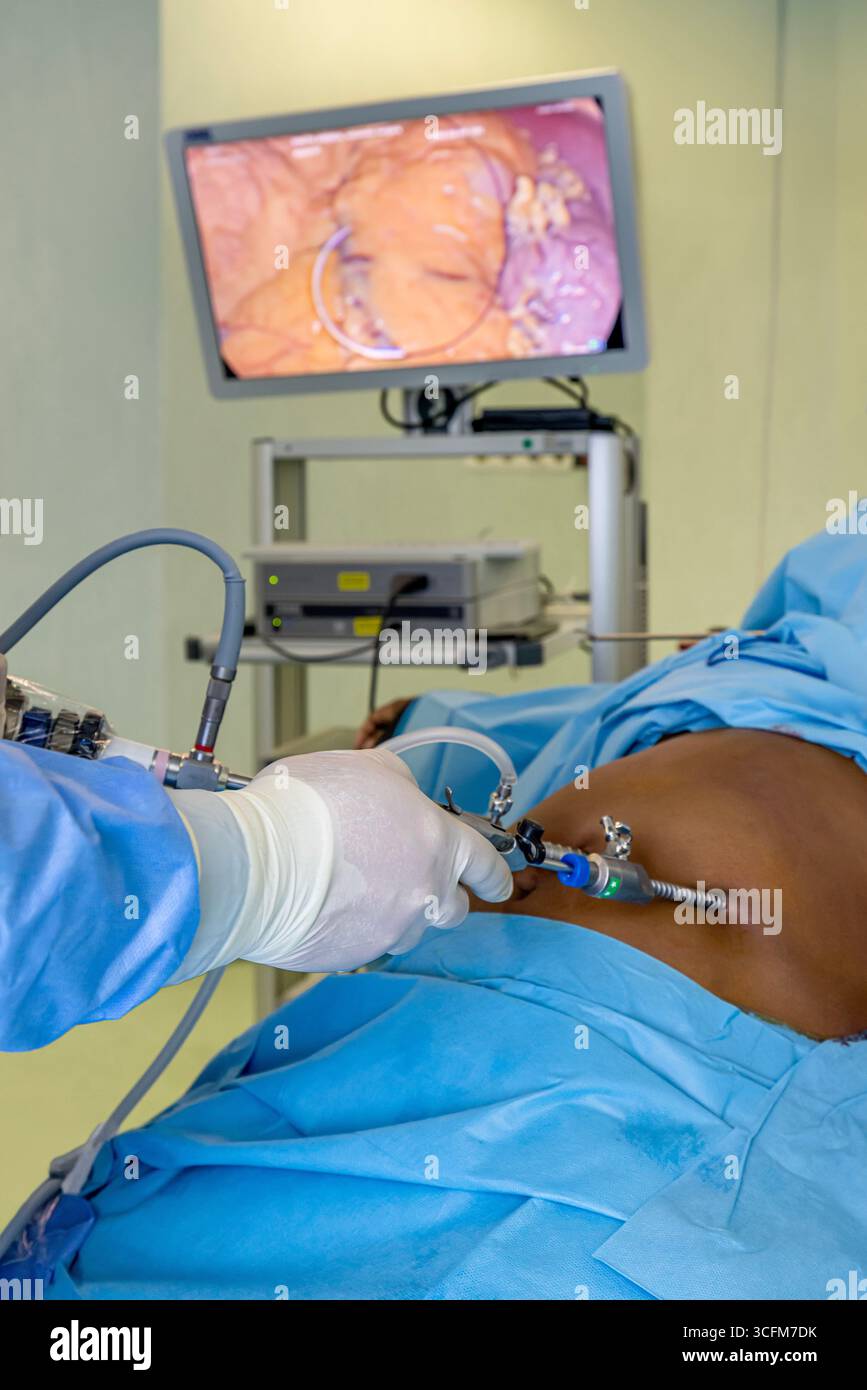 Chirurgia laparoscopica, manica gastrica, bypass gastrico, riparazione di ernia, rimozione della colecisti, gastrectomia manica, chirurgia keyhole, chirurgia bariatrica, obi Foto Stock