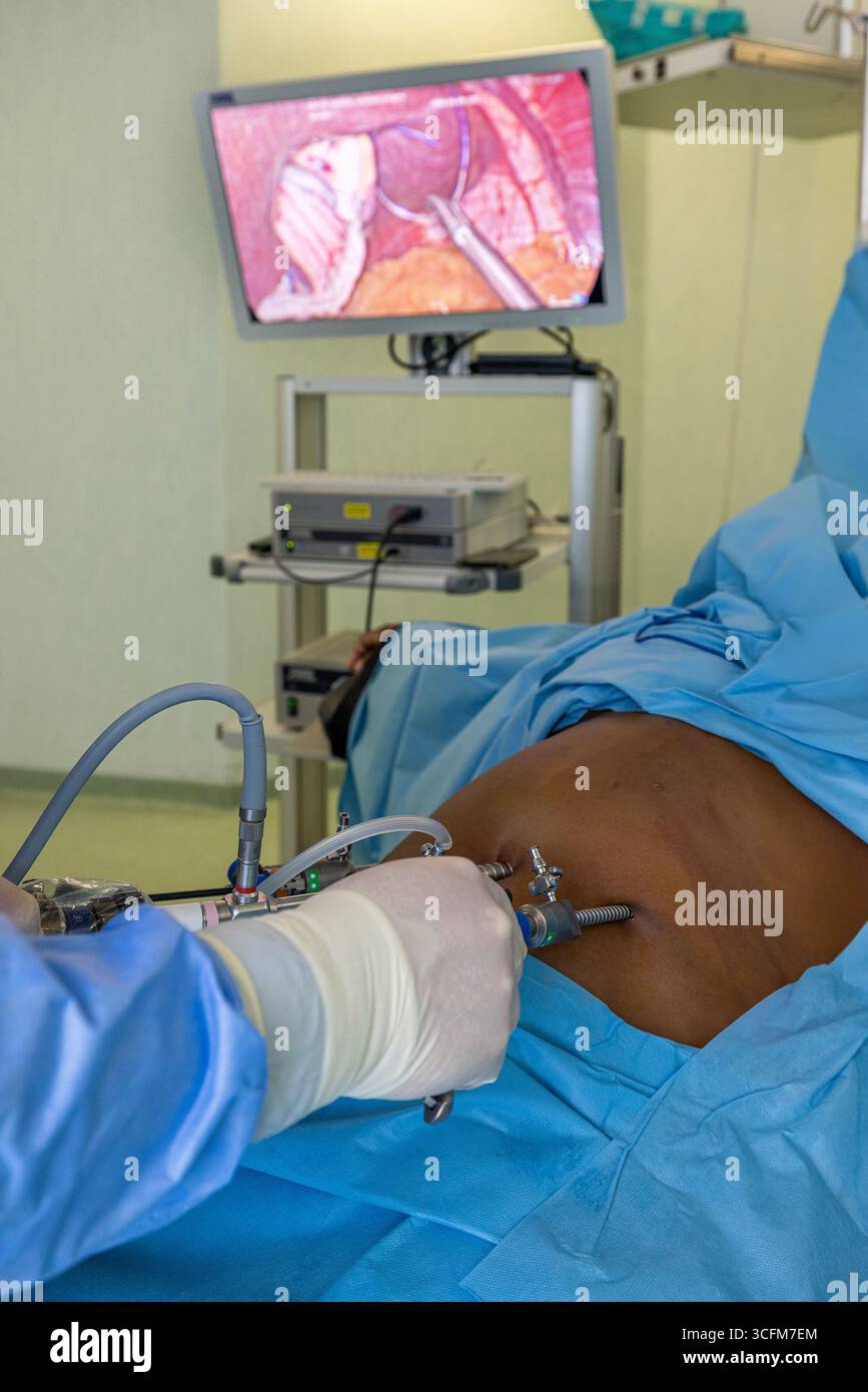 Chirurgia laparoscopica, manica gastrica, bypass gastrico, riparazione di ernia, rimozione della colecisti, gastrectomia manica, chirurgia keyhole, chirurgia bariatrica, obi Foto Stock