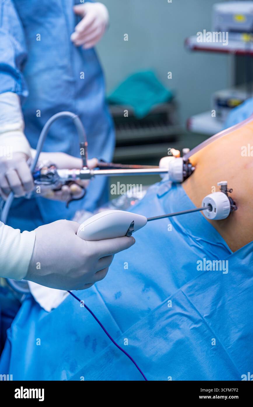 Medico che esegue l'intervento chirurgico, chirurgia laparoscopica del manicotto, messa a fuoco selettiva. Ritratto di intervento di bypass gastrico in ospedale. Foto Stock