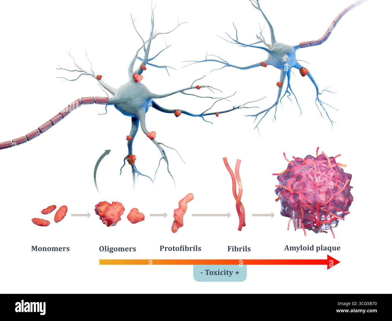 Diagramma che mostra diversi passi che portano alla formazione di placche amiloidi nella malattia di alzheimer. Illustrazione digitale, rendering 3D. Foto Stock