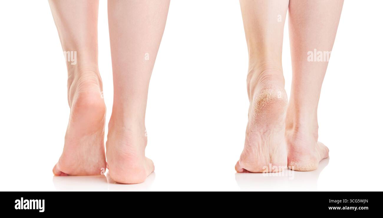 Suola femminile asciutta e fessurata di piedi e piedi femminili puliti pedicure isolati su sfondo bianco con percorso di ritaglio. Primo piano prima e dopo il risultato. Foto Stock