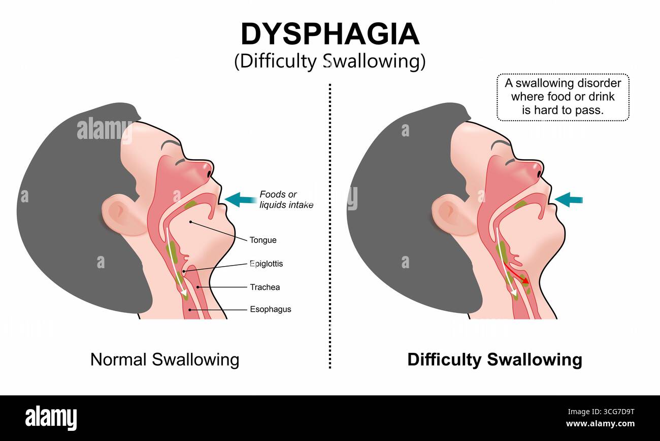Disfagia difficoltà a deglutire illustrazione medica flashcard Foto Stock