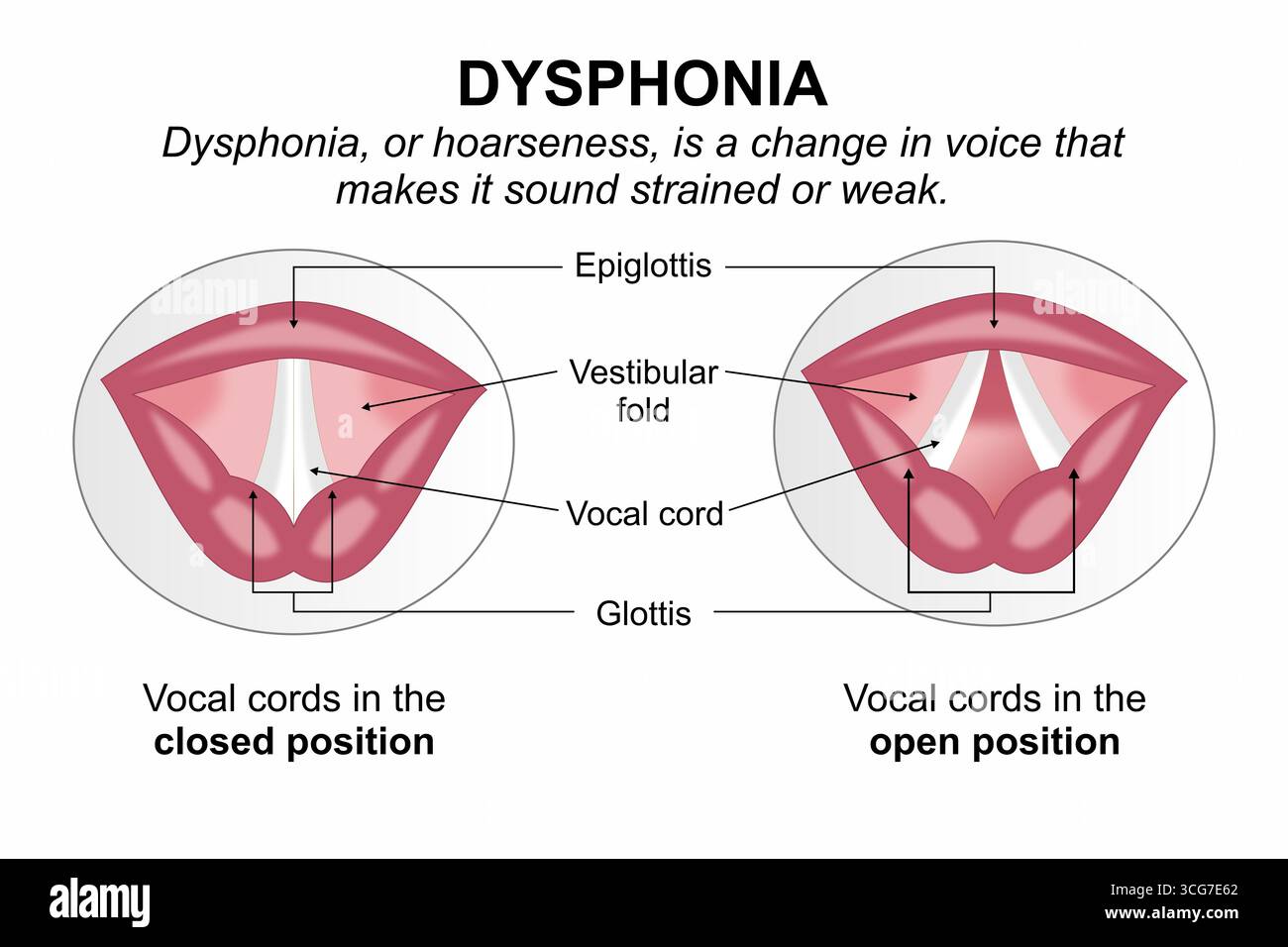 Illustrazione della scheda didattica medica della disfonia (raucedine) Foto Stock