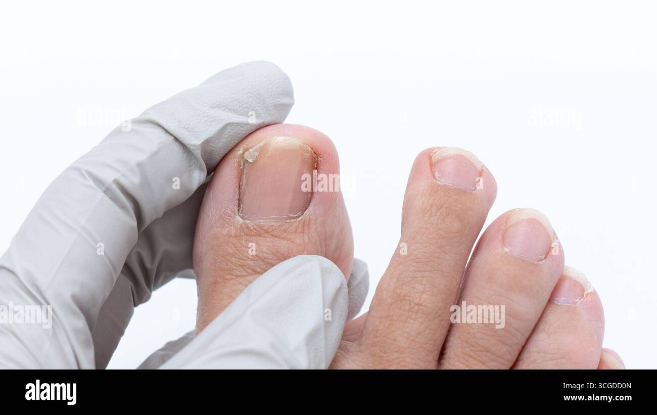 Vista ravvicinata del fungo dell'unghia del piede che viene esaminato da una mano con i guanti, mostrando gli effetti della condizione sulla salute del piede e la cura della persona Foto Stock