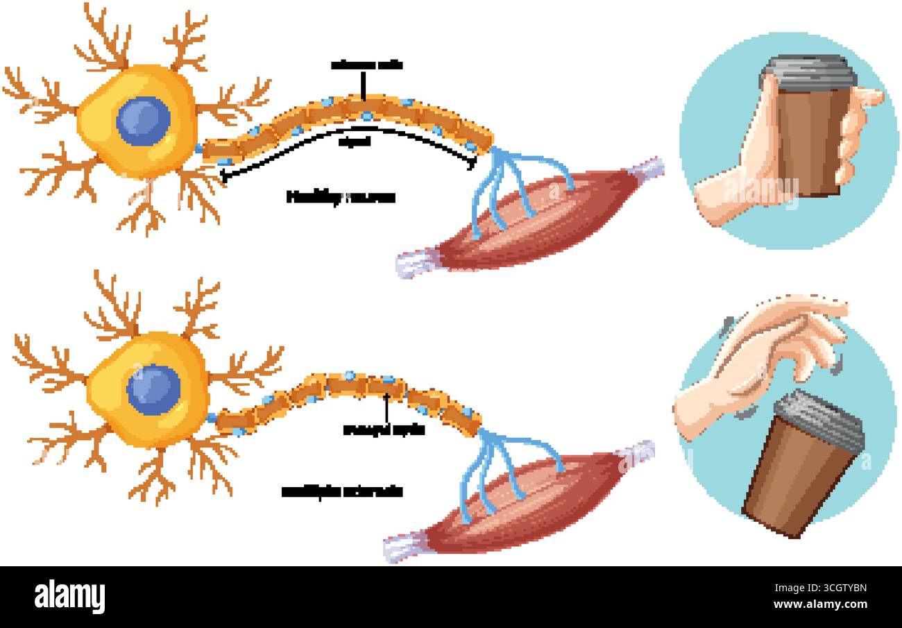 Illustrazione vettoriale che confronta neurone sano e neurone sclerosi multipla con danno mielina e tremore della mano. Illustrazione Vettoriale